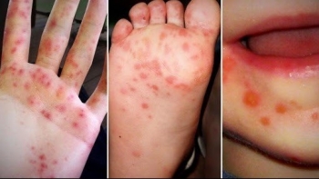 Hà Nội ghi nhận 313 trường hợp mắc tay chân miệng trong tuần qua